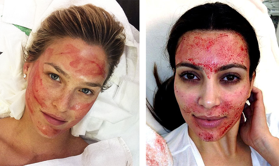 что такое PRP-лифтинг