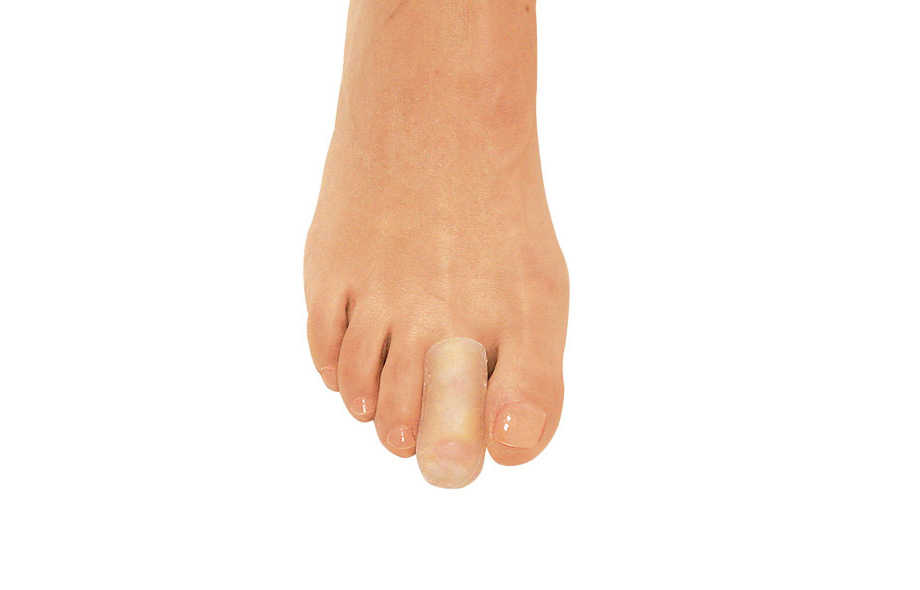 Онихолизис