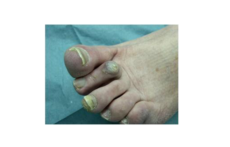 Онихолизис