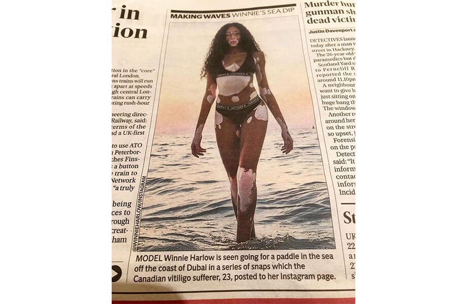 Винни Харлоу витилиго