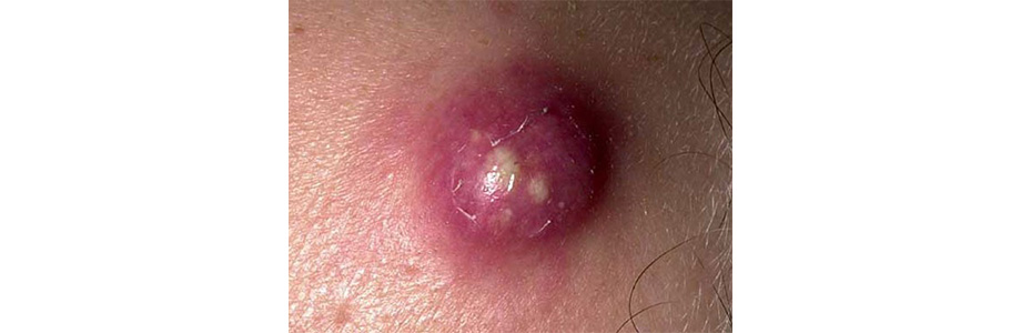 Виды прыщей