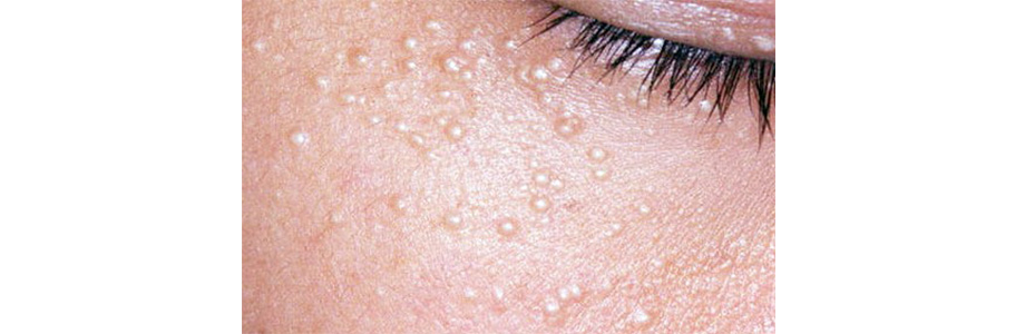 Виды прыщей