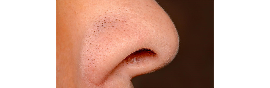 Виды прыщей