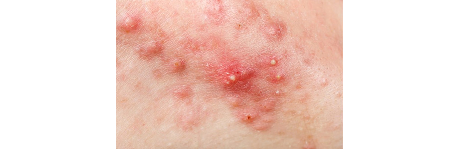 Виды прыщей