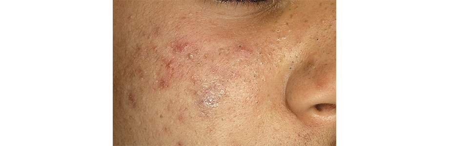 Виды прыщей