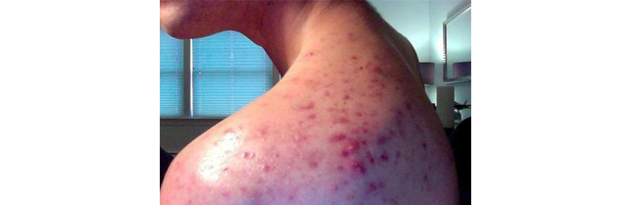 Виды прыщей