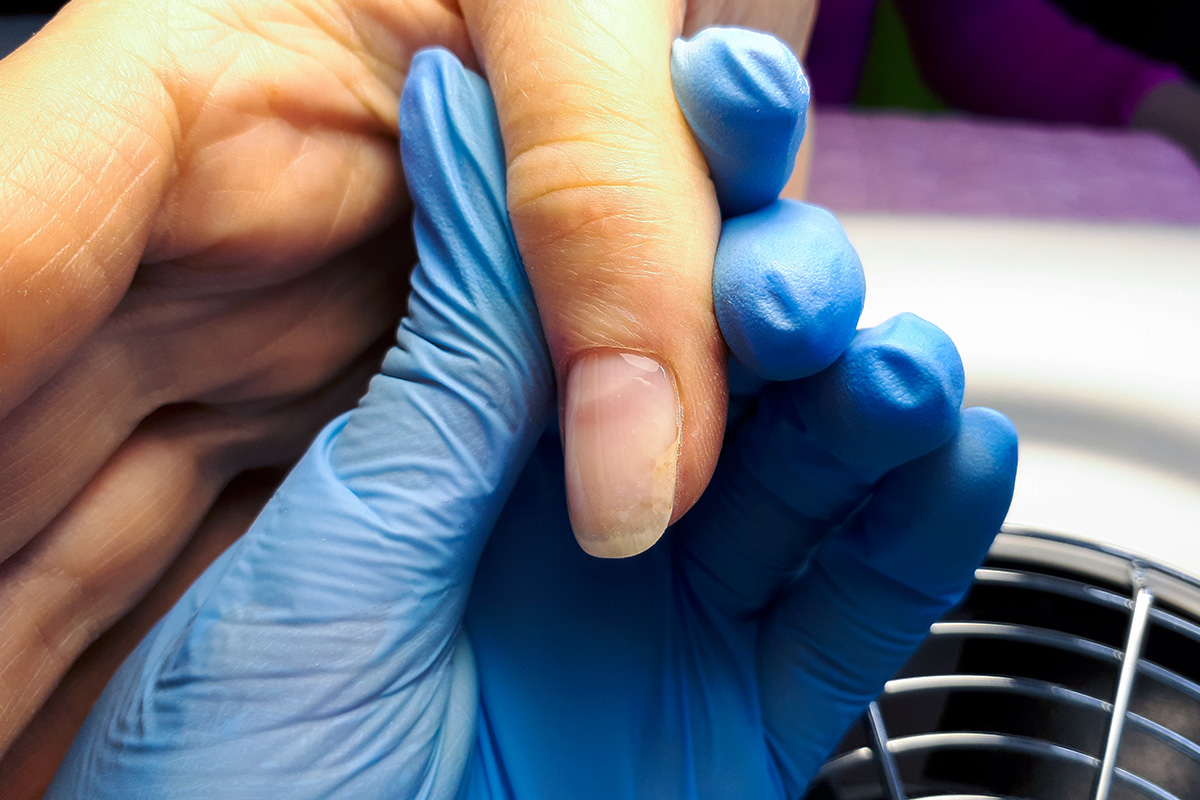 отслоение ногтя онихолизис