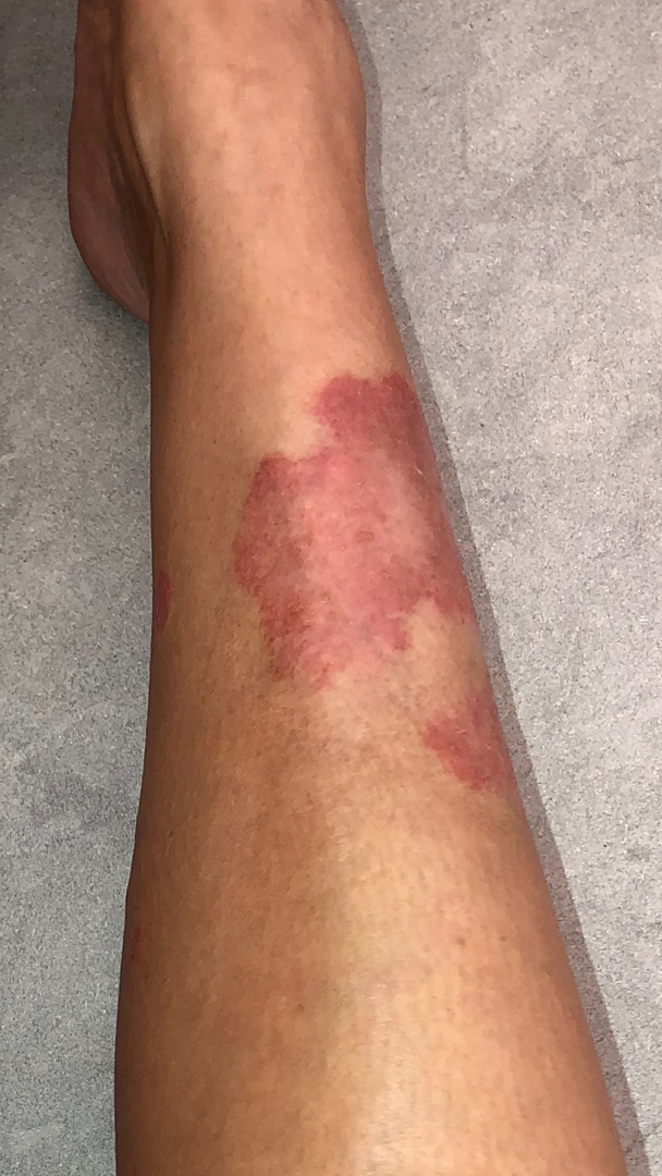 Ким Кардашьян Уэст рассказывает свою историю болезни псориазом