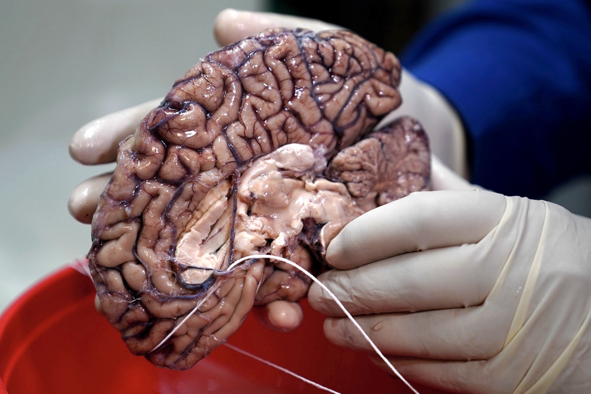 Раковые клетки способны подключатся к нейронной сети мозга