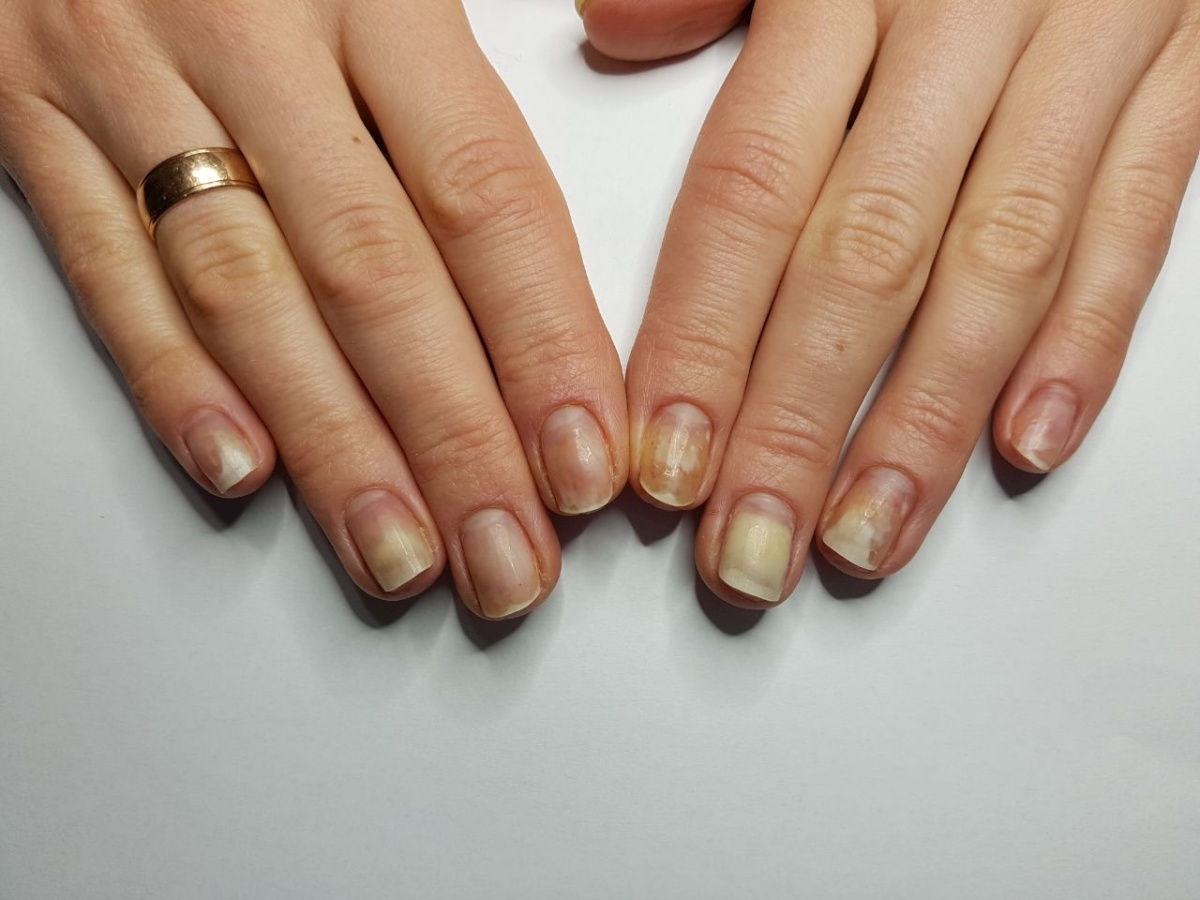 Онихолизис фото