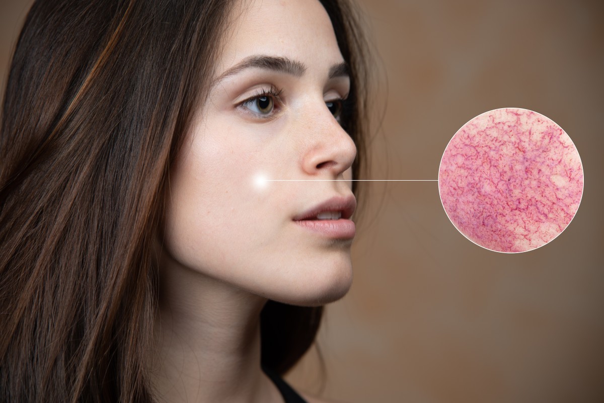 Судинні зірочки на обличчі