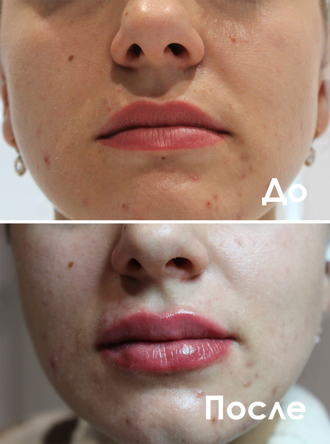 филлер в губы до после