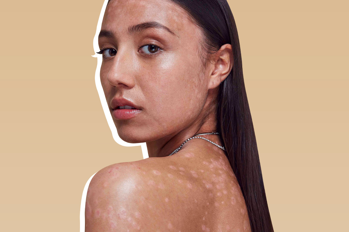 Как краситься при коже с псориазом