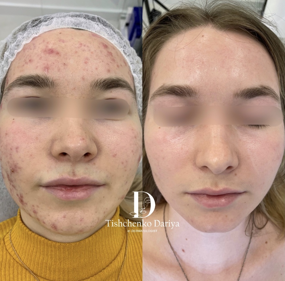 лечение акне