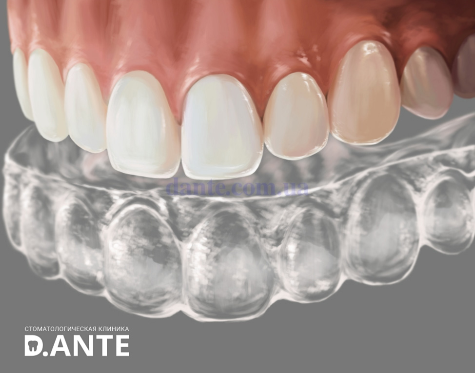 Отбеливание зубов в домашних условиях: интервью с экспертом