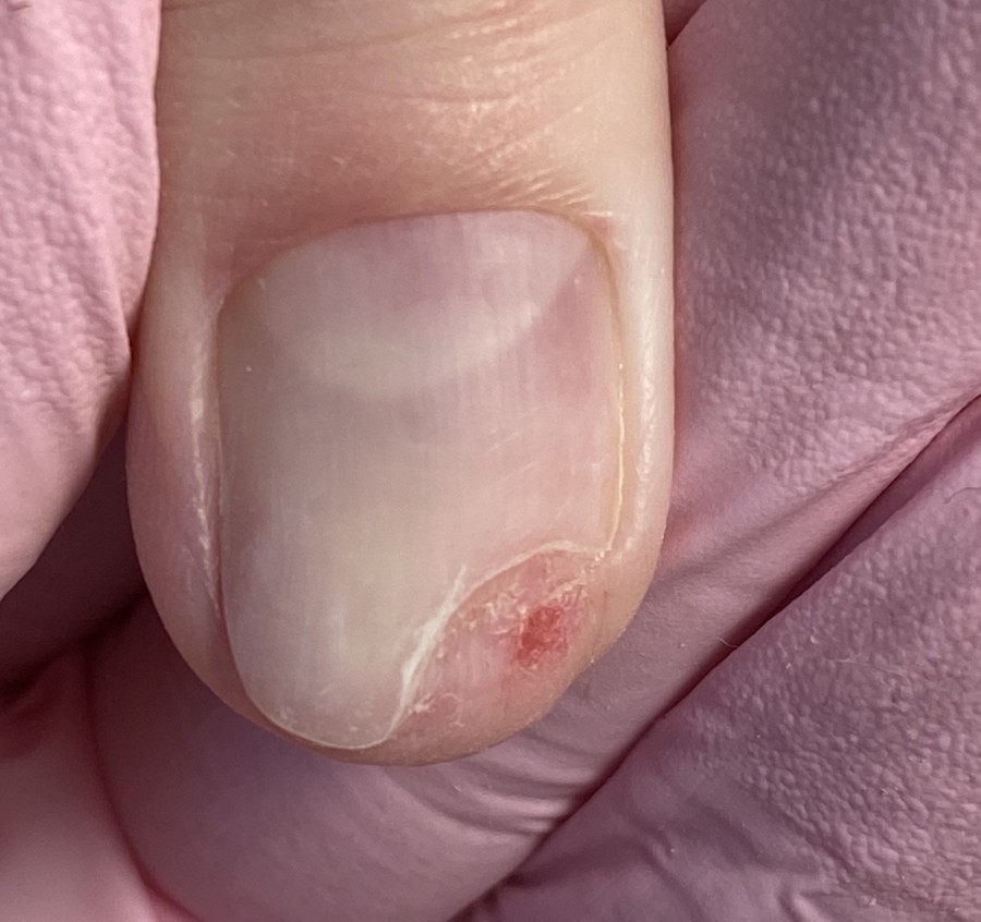 онихолизис