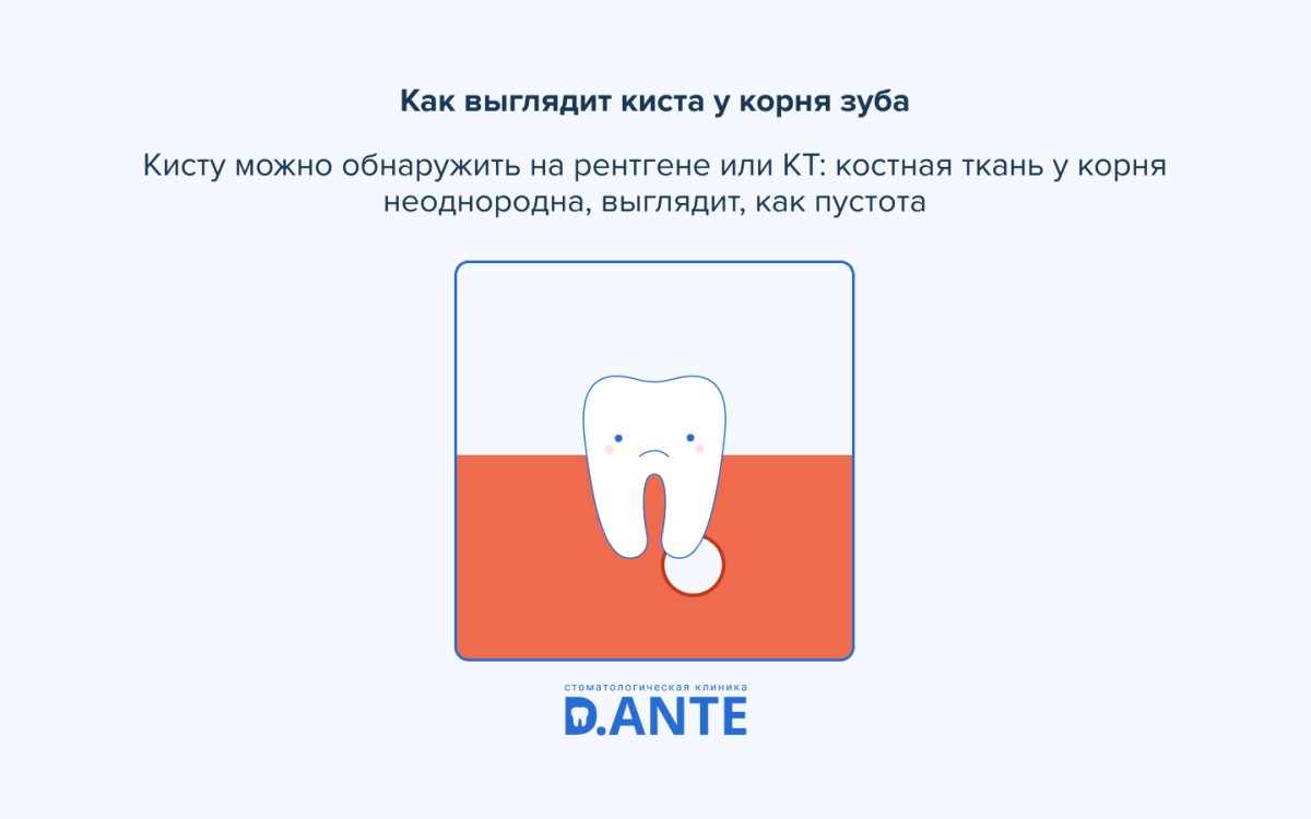 Кіста зуба: від невеликого запалення до перелому щелепи 