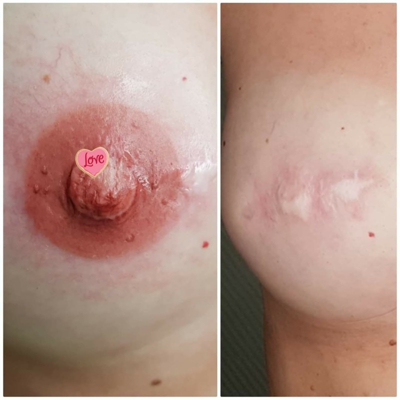 Эстетический татуаж ареол после операции