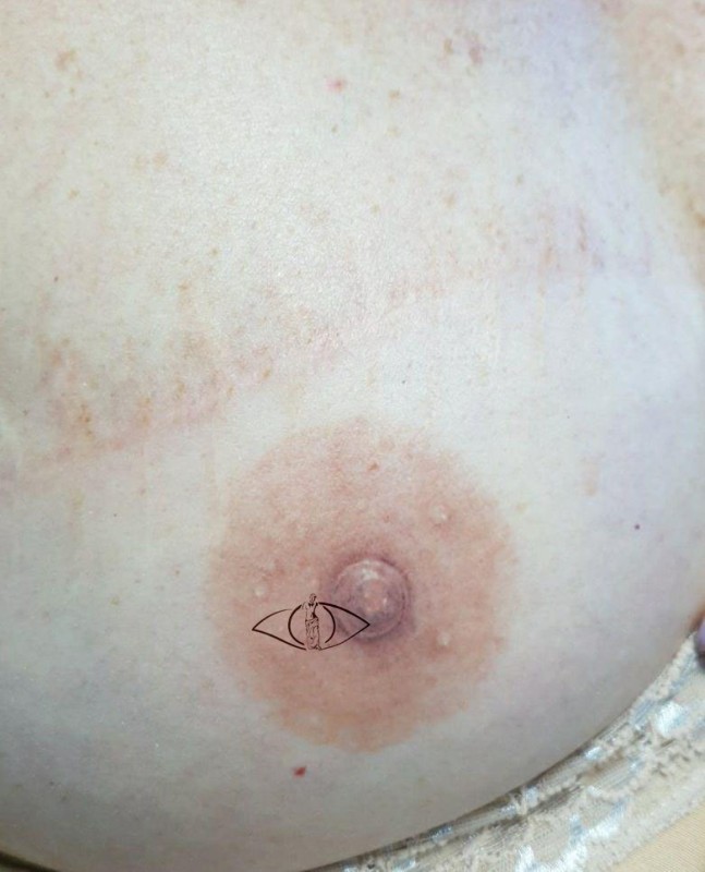 Эстетический татуаж ареол после операции