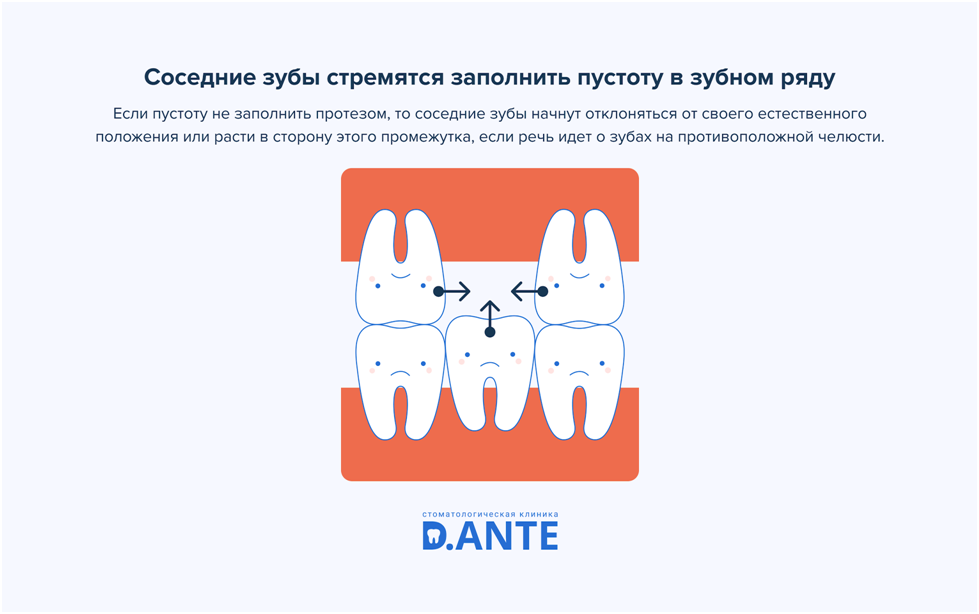 Вставні зуби