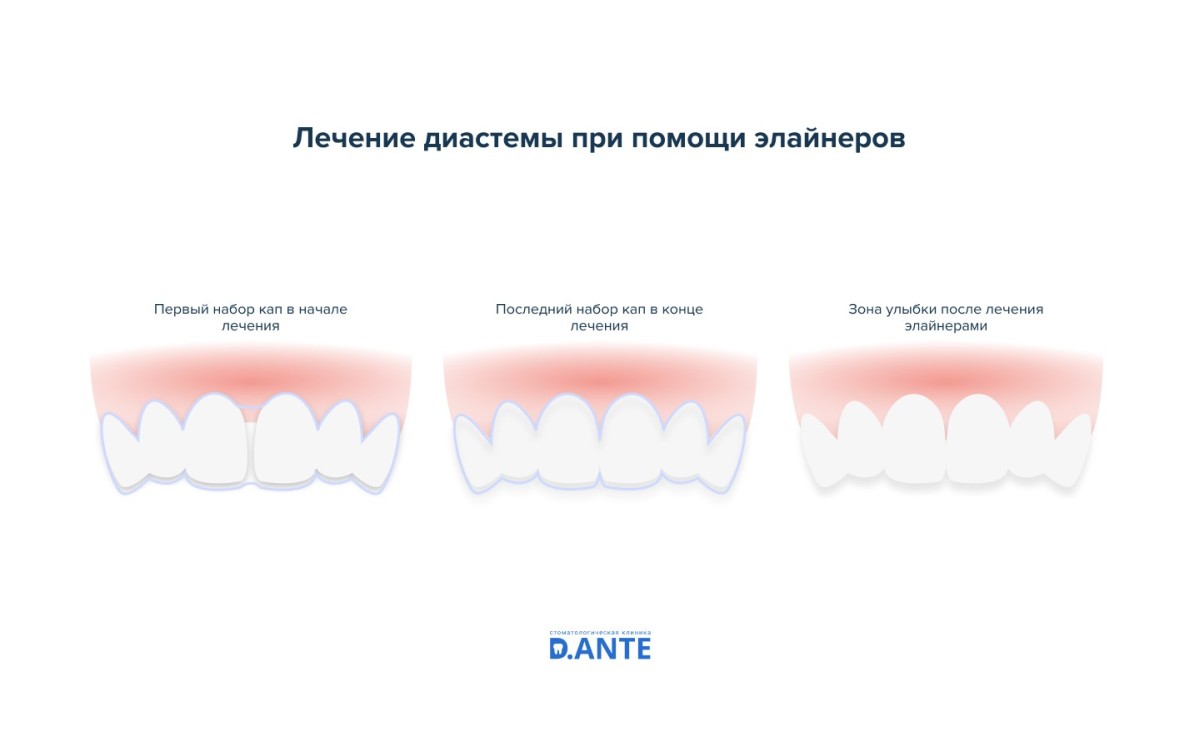 Лечение диастемы при помощи элайнеров