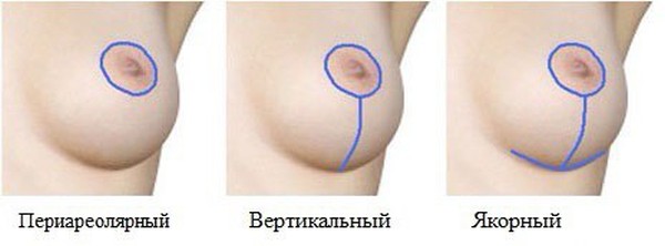 подтяжка груди