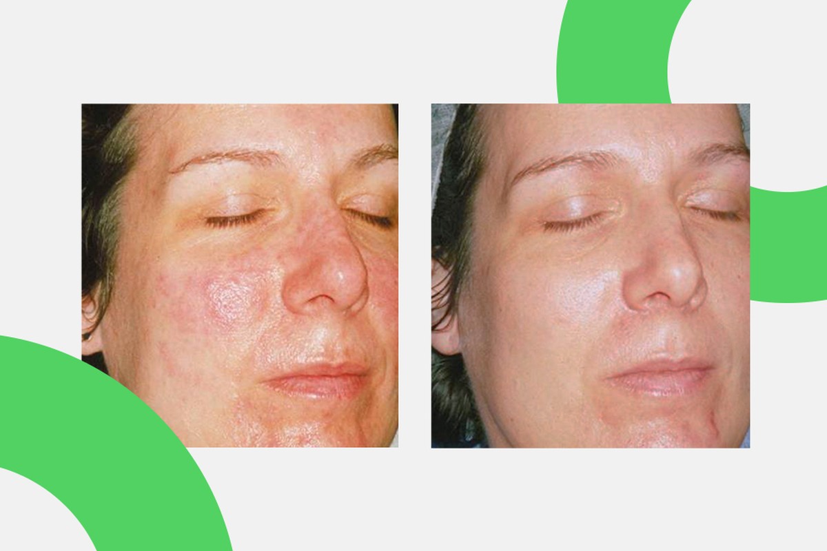 Лечение розацеа