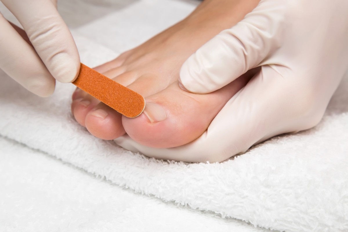 онихомикоз