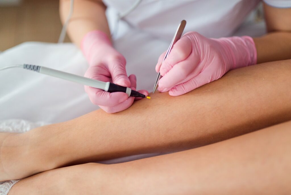 Що таке електроепіляція і чим вона відрізняється від лазерної