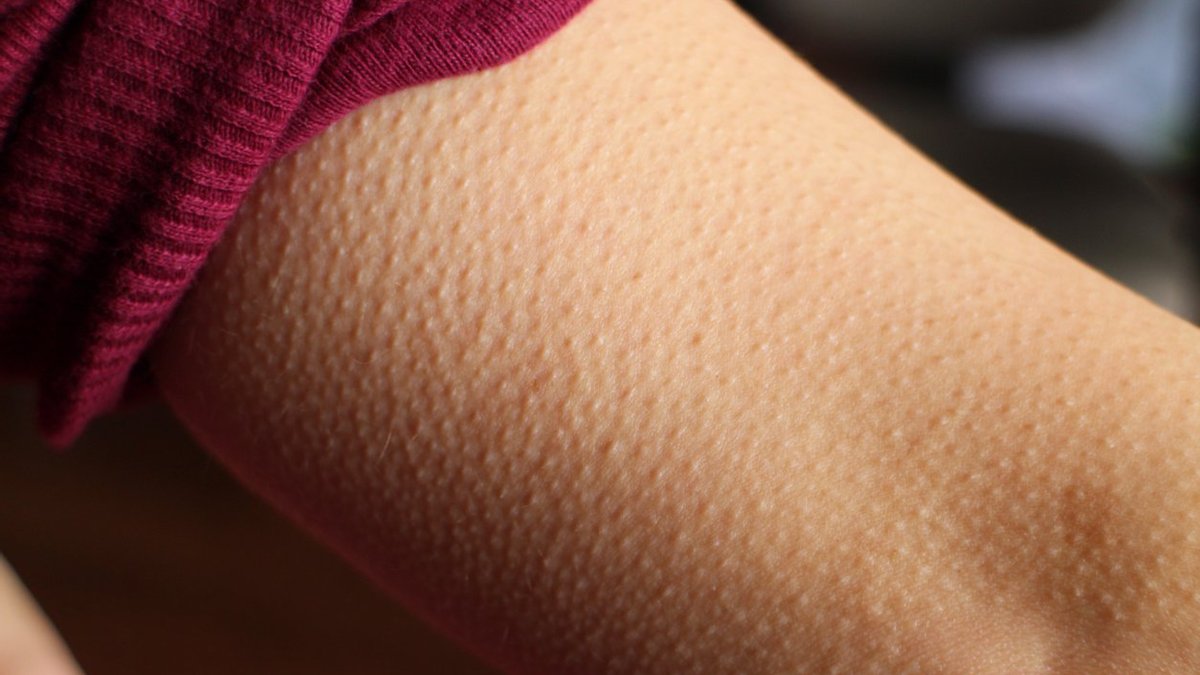 Гусиная кожа, или Как избавиться от фолликулярного кератоза