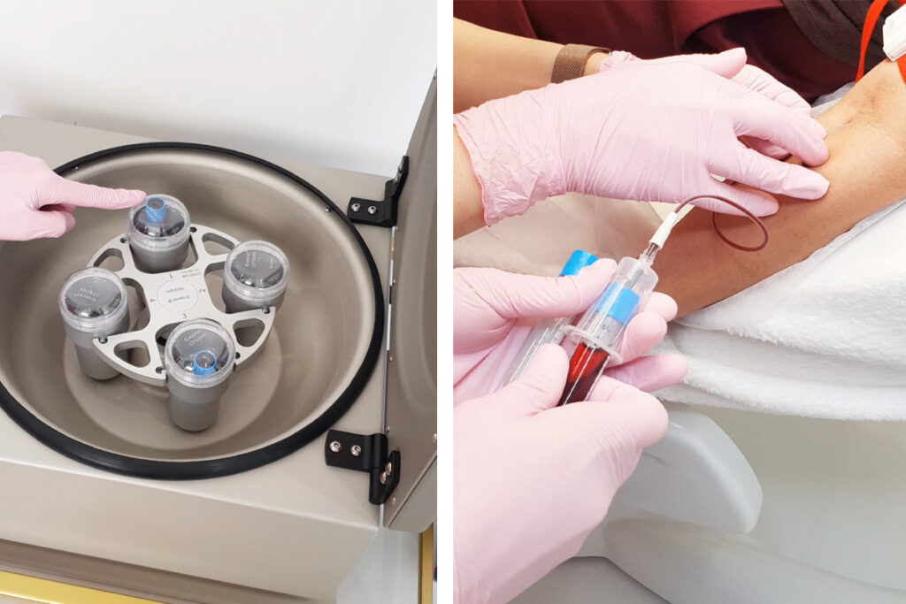 Що таке плазмоліфтинг і кому він показаний