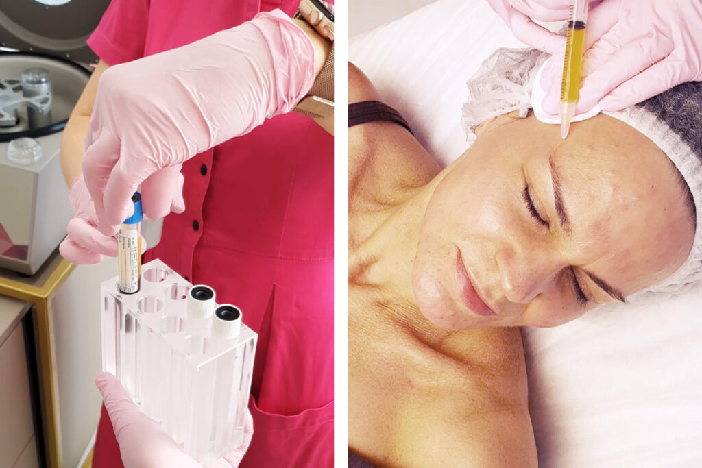 Що таке плазмоліфтинг і кому він показаний