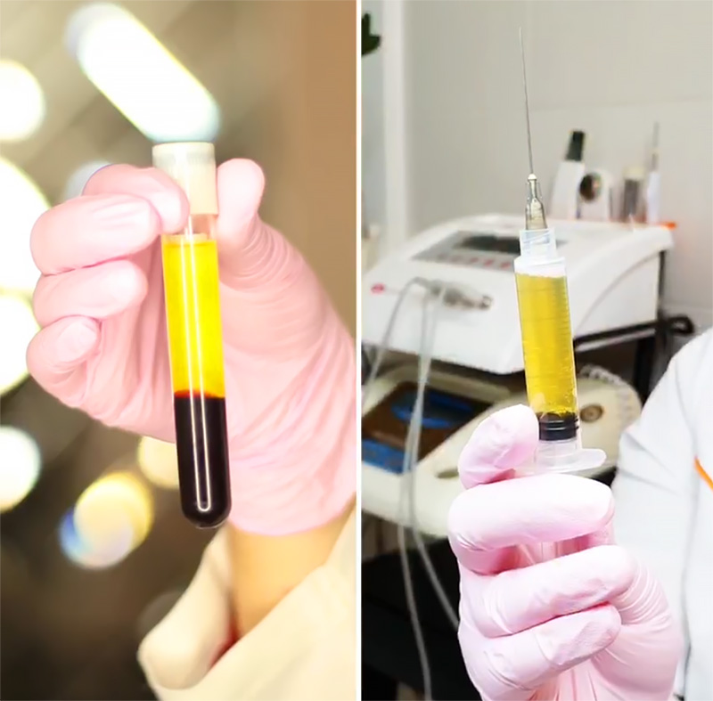 Що таке плазмоліфтинг і кому він показаний