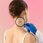 меланома это