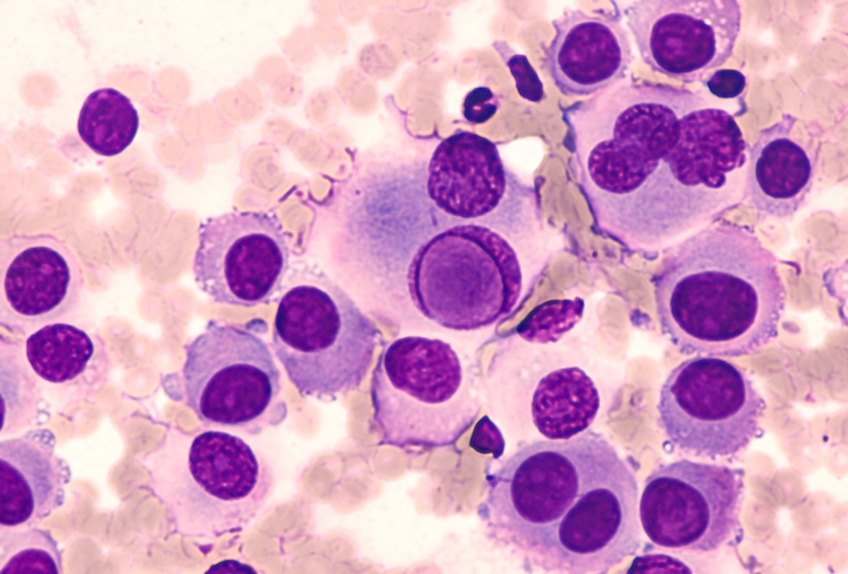 как выглядит меланома