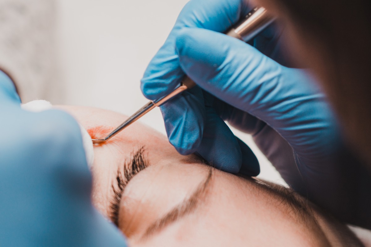 просянка как избавиться