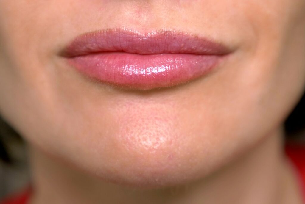 Гранулы Фордайса на губах: что это такое, лечение в домашних условиях