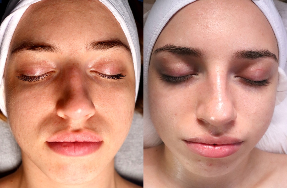 Газожидкостный пилинг для лица