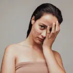 возрастное акне