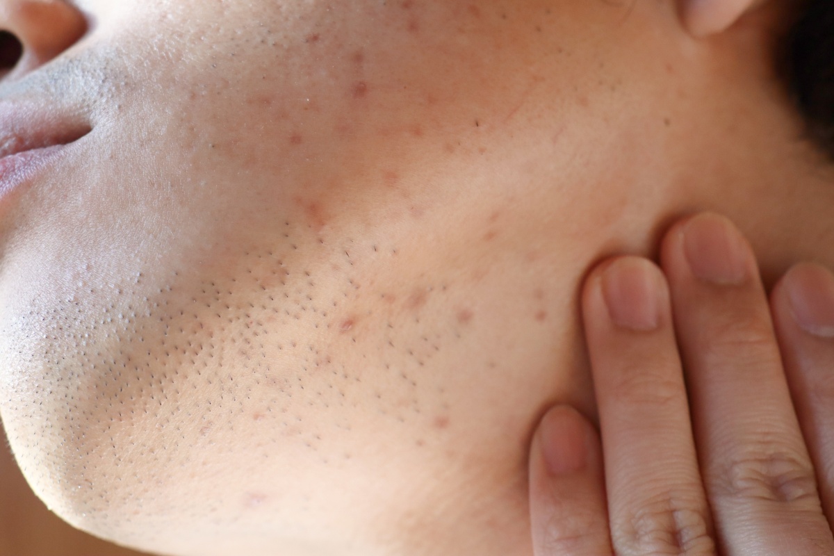 следы от акне