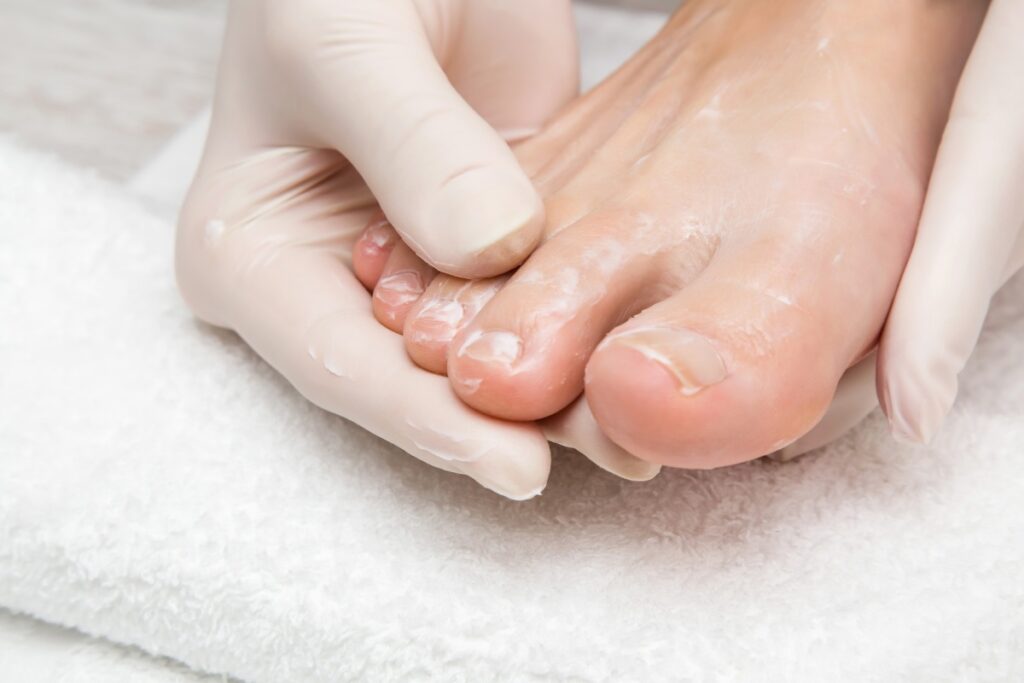 Отслоение ногтя: почему происходит и как лечить онихолизис