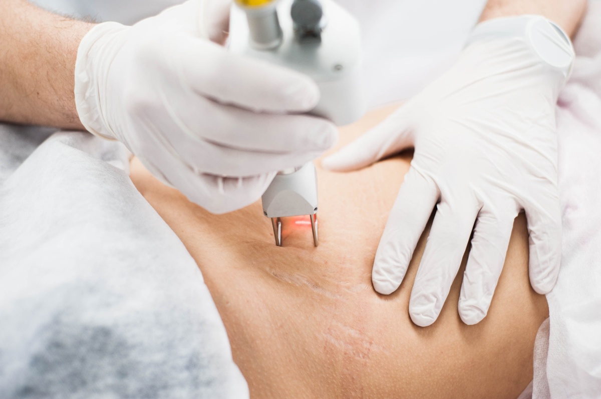 Як прибрати розтяжки