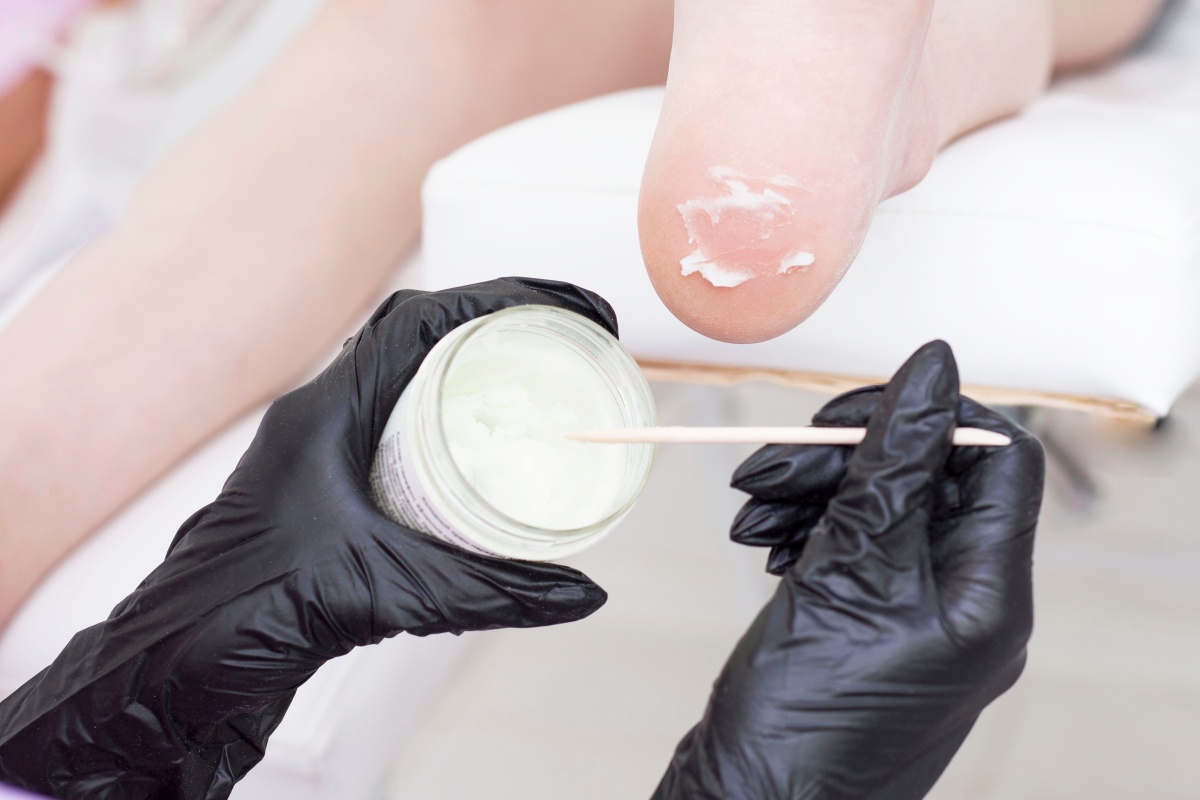 Гіперкератоз