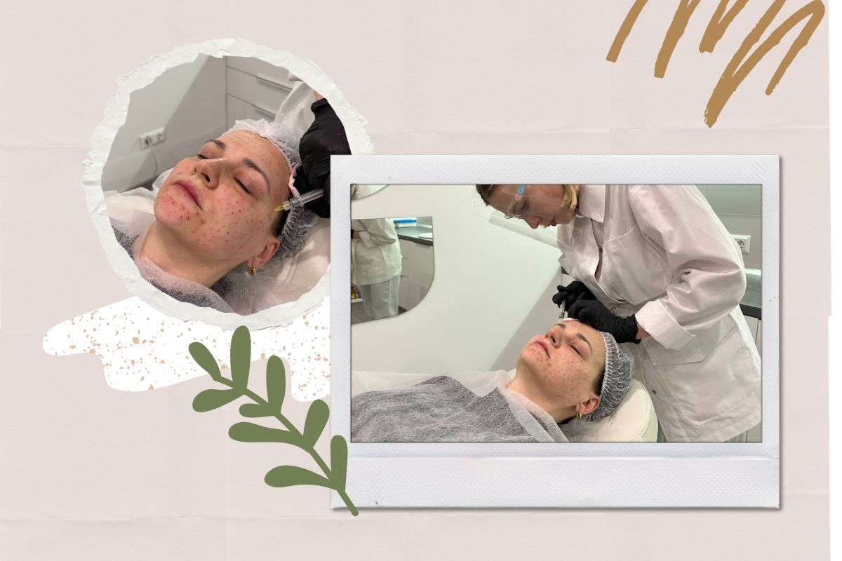 редермалізація як проводиться